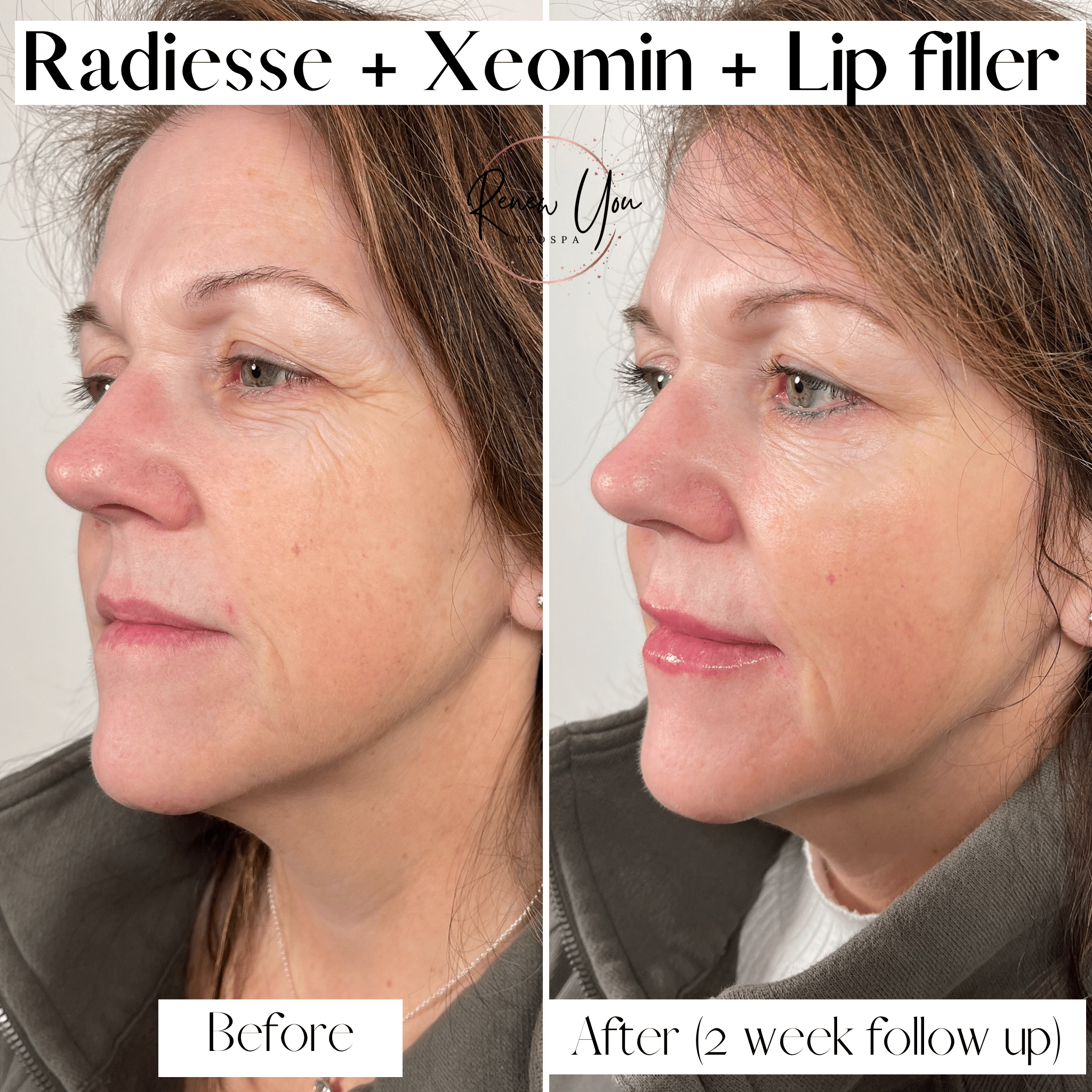 Before and After Image: Radiesse/Xeomin/Lip Filler - left-front-oblique
