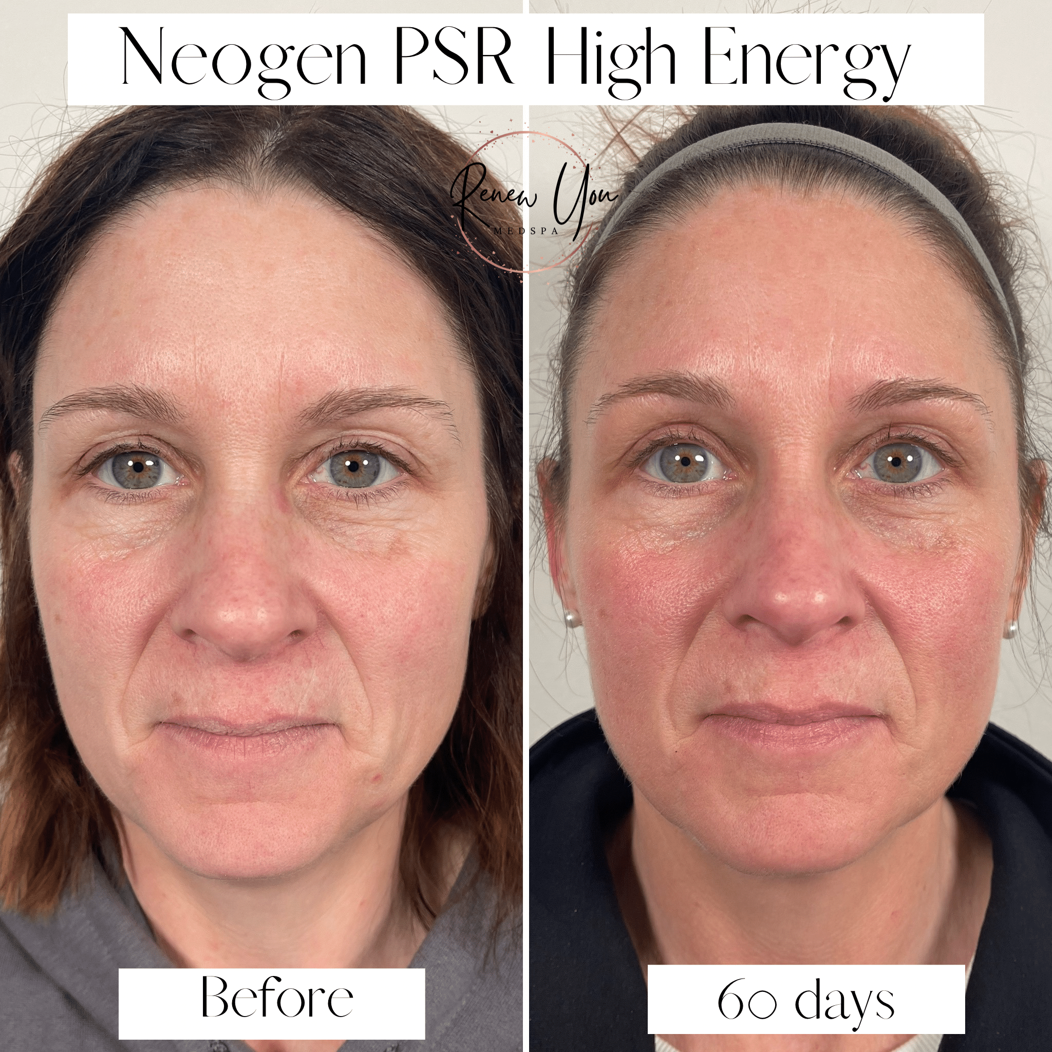 Before and After Image: Neogen High Energy - front