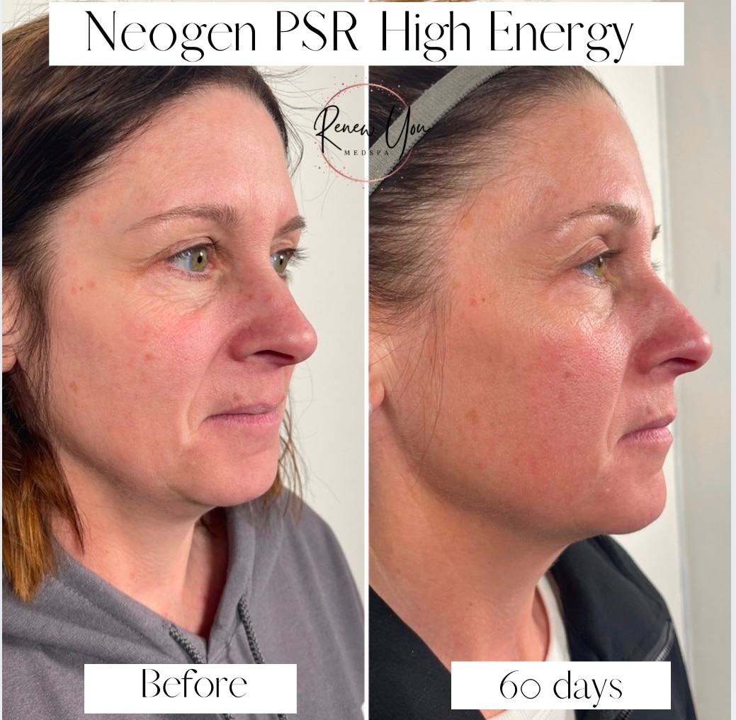 Before and After Image: Neogen High Energy - right-front-oblique