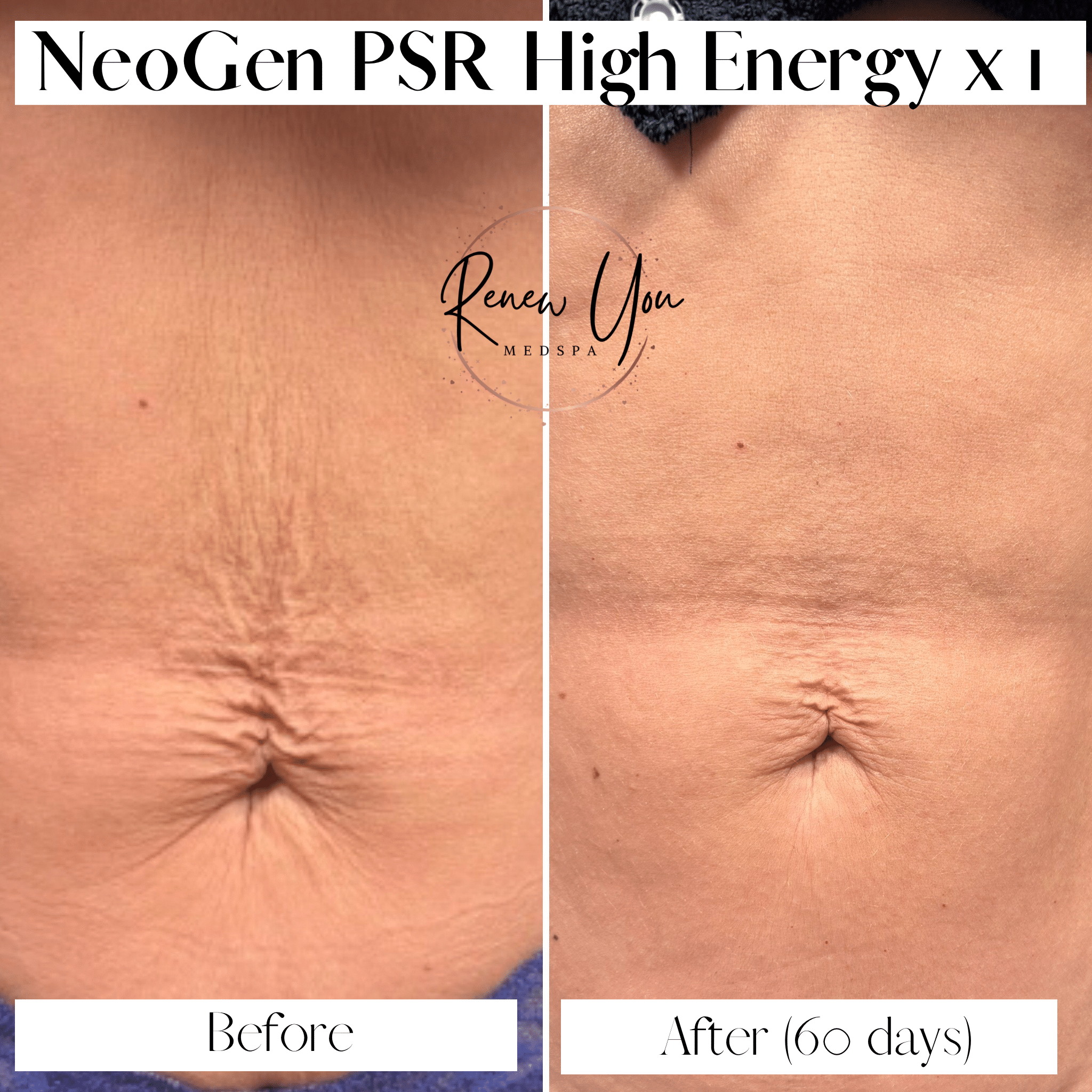 Before and After Image: Neogen PSR - front